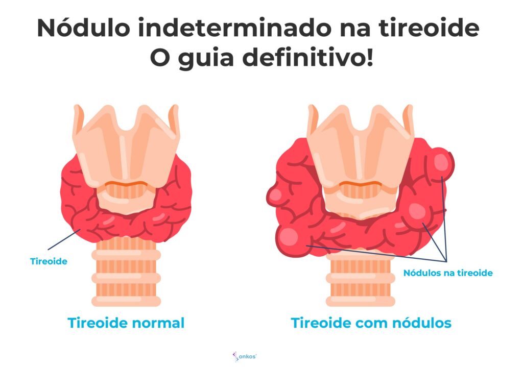 Nódulo indeterminado na tireoide – O guia definitivo!