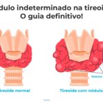 Nodulo na tireoide